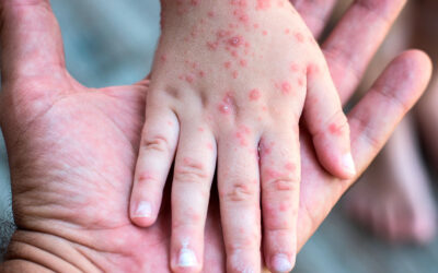 Alerta sanitaria, posible contagio masivo de sarampión